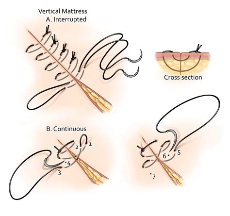 Professional /. Figures /. ... /. Horizontal mattress suture /. The needle and suture follow a path from point 1 to point 4, as described in the Step-by-Step Description of Procedure. …